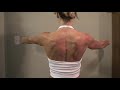 Damaged Long Thoracic Nerve - Winging Scapula- Post Surgery Damaged Long Thoracic Nerve - Winging Scapula- Post Surgery