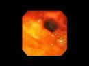Crohn disease