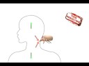 Tick Paralysis (Its Educational)