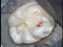 Endodontic treatment of lower molar