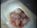 Endodontic treatment of lower molar with deep decay. Also shows interaction between NaOCl and EDTA.