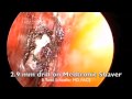 Correction of Choanal Atresia Correction of Choanal Atresia