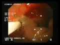 Bleeding From Duodenal Bulb - Laserotherapy Bleeding From Duodenal Bulb - Laserotherapy