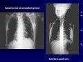 Radiologia de torax