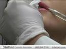 Lip Augmentation Procedure with Juv�derm?  Dermal Filler