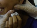 Gross Boil On Girl's Face