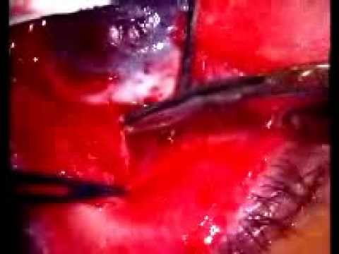 how to treat graft vs host disease