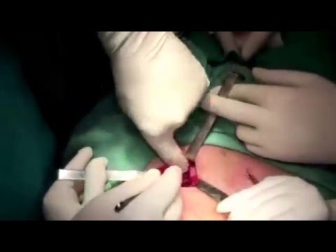 Πλαστική Αποκατάσταση βουβωνοκήλης