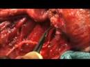 The Trotter Procedure The Trotter Procedure