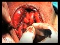 Urologia.URETROPLASTIA CON INJERTO DORSAL PREPUCIAL Y COLGAJO PENEANO ANTERIOR.