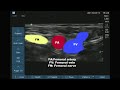 Ultrasound Guided obturator nerve block
