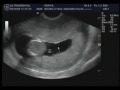 Emanuelly (Ecografia Gestacional 06-10-2009).mpeg
