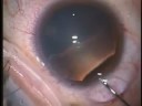 ICL Surgery (Shimizu)