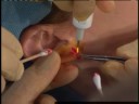 Earlobe Reconstruction Surgery