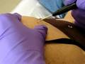 Mole Removal Surgery Clinic - cosmetic radiosurgery