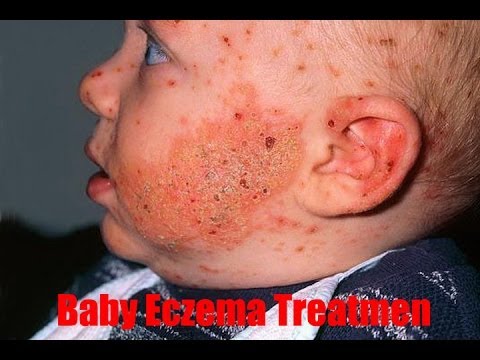 how to treat baby eczema naturally