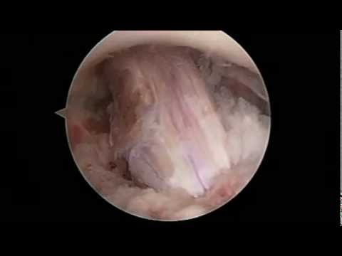 how to repair mcl