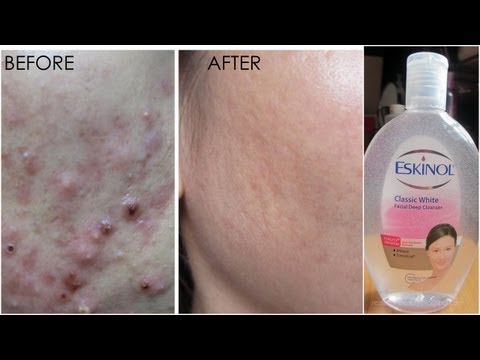 Inexpensive Acne Solution - ESKINOL and Dalacin C