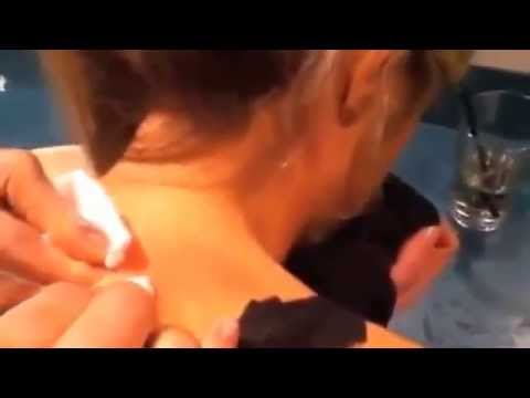how to drain sebaceous cyst at home