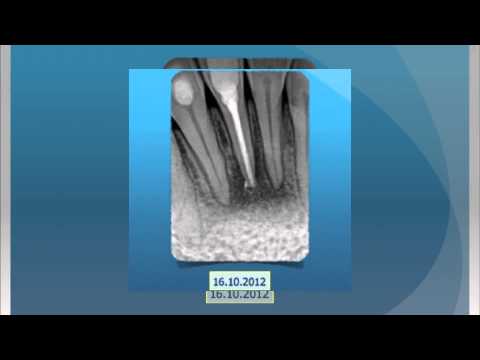 how to treat a periapical and a apex abscess on tooth