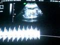 videos de Ultrasound