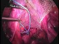 Sacropromontopexia Laparosc�pica