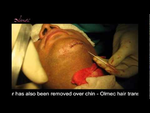 how to remove hair transplant scar