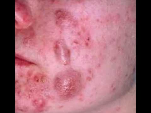 how to stop cystic acne