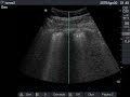 Patr�n intersticial
