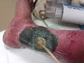 Wound VAC Dressing change 2 of 2