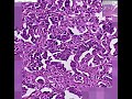 Histopathology Ovary-- Adenocarcinoma