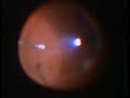Retinal Surgery