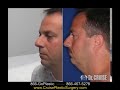 Neck Lift / Chin Implant / Rhinoplasty Part 2, Dr. Cruise