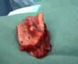 The Cervicofacial Advancement Flap