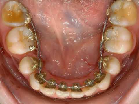 orthodontie linguale incognito