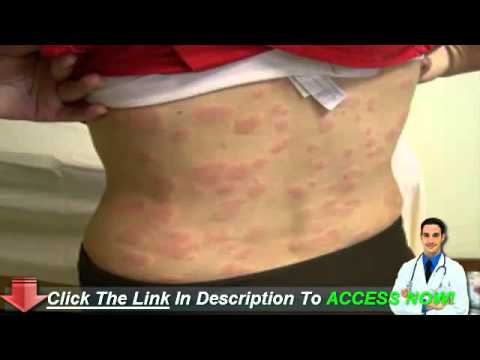 how to cure idiopathic urticaria