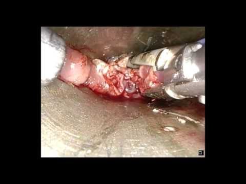 how to treat zenker's diverticulum