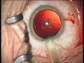 Visian ICL implantation and retropupillary placement 3 cases Visian ICL implantation and retropupillary placement 3 cases