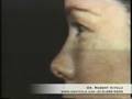 videos de New York Plastic Surgery Teenage Rhinoplasty w/ Dr. Vitolo