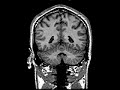 MRI scan 2 MRI scan 2