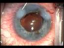 Wound hydration and Injection of Intracorneal and Intracamer Wound hydration and Injection of Intracorneal and Intracamer