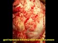 Craniosynostosis-surgical correction-dr suresh dugani/HUBLI/KARNATAK/INDIA