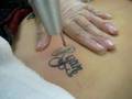Tattoo lézeres eltávolitás -  Laser Tattoo Removal