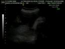 Leonardo Rondina Salgado 4D - 31 semanas