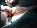 videos de HERNIA