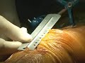 Computer assisted orthopedic surgery - minimally invasive