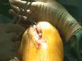Computer assisted orthopedic surgery - minimally invasive