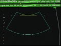 GRAVIMAGEM 916 (ULTRA-SOM 3D 4D GRAVIDEZ  COM 21 SEMANAS)
