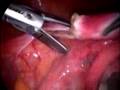 Total Laparoscopic Hysterectomy Using Electrosurgery