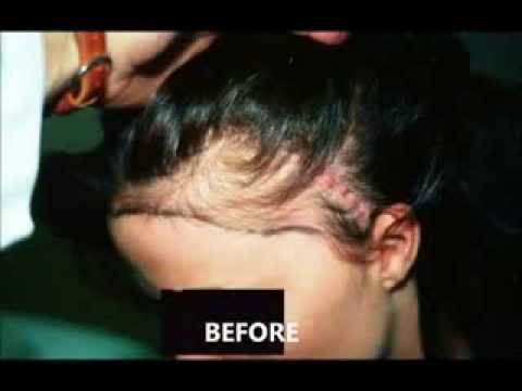 how to do hair transplant yourself